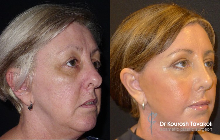 Facial Fat Graft Case Study 1 Image 1 - Dr Kourosh Tavakoli