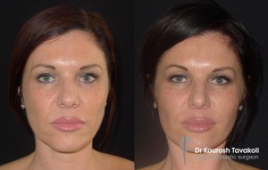 Facial Fat Graft Case Study 3 - Front View