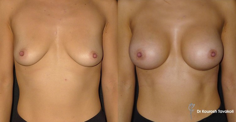 Green zone - deflated breasts before and after breast lift / mastopexy.