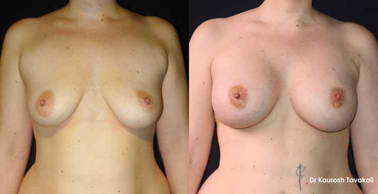 Bilateral breast augmentation to correct ptosis using Mentor CPG 333 485cc implants.