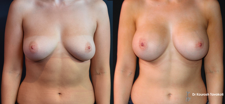 YELLOW ZONE: Bilateral breast augmentation using Mentor CPG 333 330cc high profile implants.