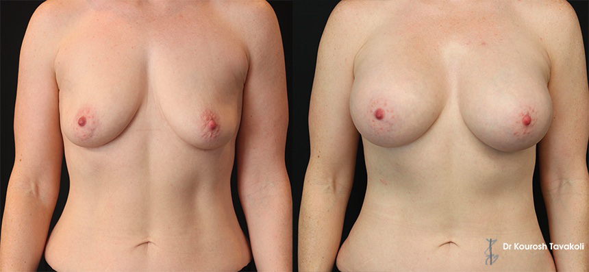 YELLOW ZONE: Bilateral breast augmentation to correct ptosis. Submuscular placement of Mentor CPG 333 545cc implants.