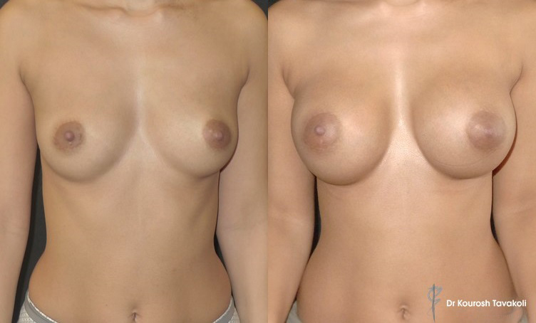 Bilateral Breast Augmentation using Mentor CPG 333-290cc anatomical (teardrop) implants. Dual plane, submuscular pocket.