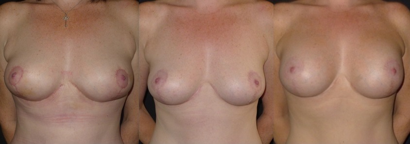 2 STAGE LIFT breast lift by Dr Kourosh Tavakoli in Double Bay Sydney 2029 Breast Lift (Mastopexy) Sydney - 6