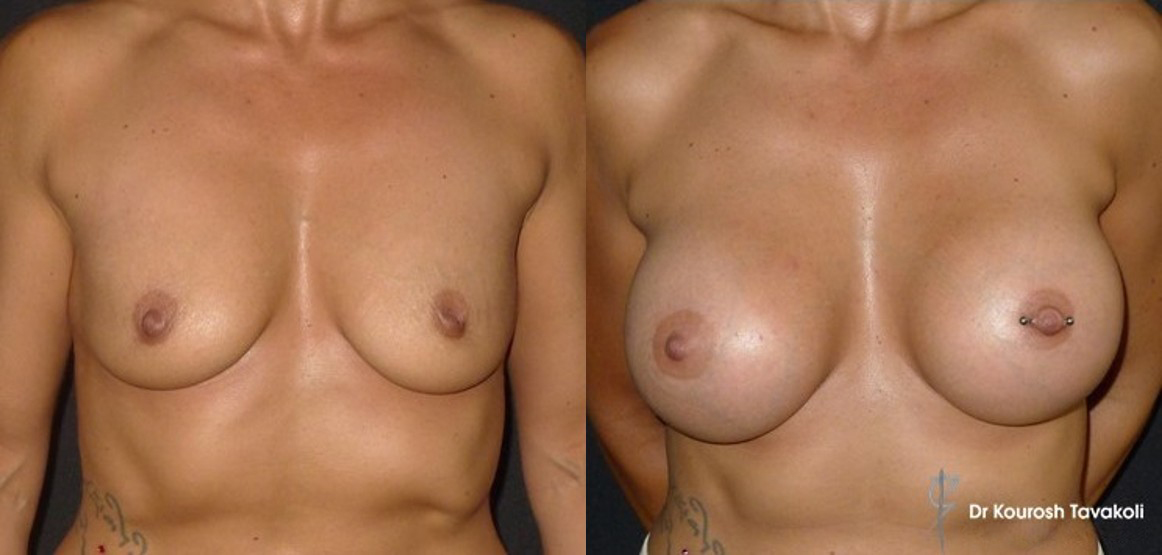 GREEN ZONE2 breast lift by Dr Kourosh Tavakoli in Double Bay Sydney 2029 Breast Lift (Mastopexy) Sydney - 3
