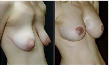Complex Breast Lift and Reduction plus Augmentation in a 26 year old with tuberous breast deformity, severe Ptosis and sever chest wall deformity. Results at 7 months.