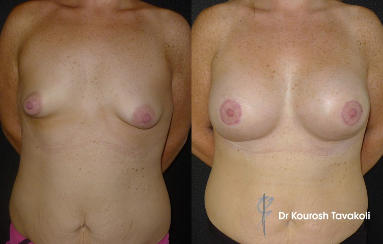 27yo female, nil pregnancies, Breast Asymmetry and Tuberous breast deformity grade 3, CPG 445cc-332, tall height, moderate profile, teardrop silicone gel implants, placed dual-plane. 