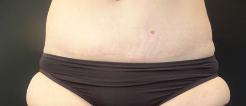 Tummy tuck abdominoplasty before photo