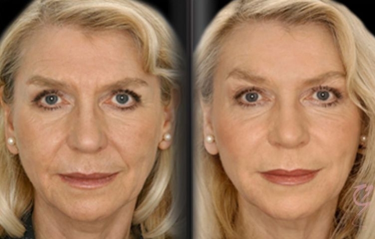 Before and after Dermal Fillers.