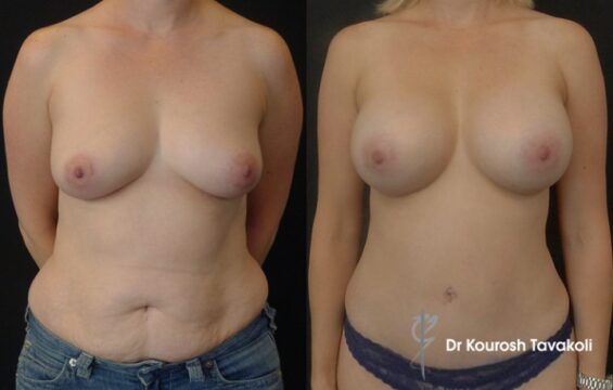 breast augmentation abdominoplasty dr tavakoli 2015 Women Body Galleries - 1