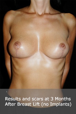 Clinical sequence of mastopexy breast lift 2