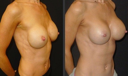 Simple exchange of breast implant