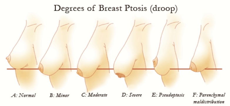 Degrees of breast ptosis (droop)