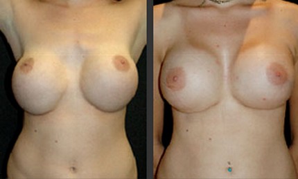 Breast implant bottoming out correction