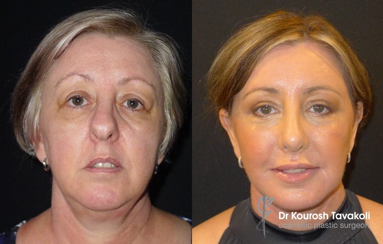 Facial Fat Graft Case Study 1 Image 2 - Dr Kourosh Tavakoli
