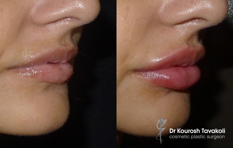 Before and after injectables in lips.