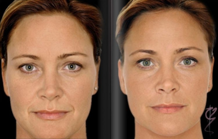Before and after use of injectables in face.