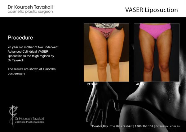 Liposuction before and after by Dr Kourosh Tavakoli