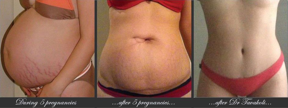 Post pregnancy makeover - before, during and after photos