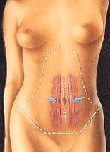 Tummy tuck abdominoplasty operation clinical diagram 3