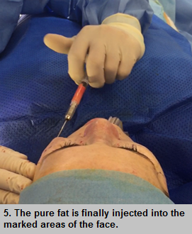 fat graft face surgery dr tavakoli 5 Fat Graft for Facial Contouring - 5