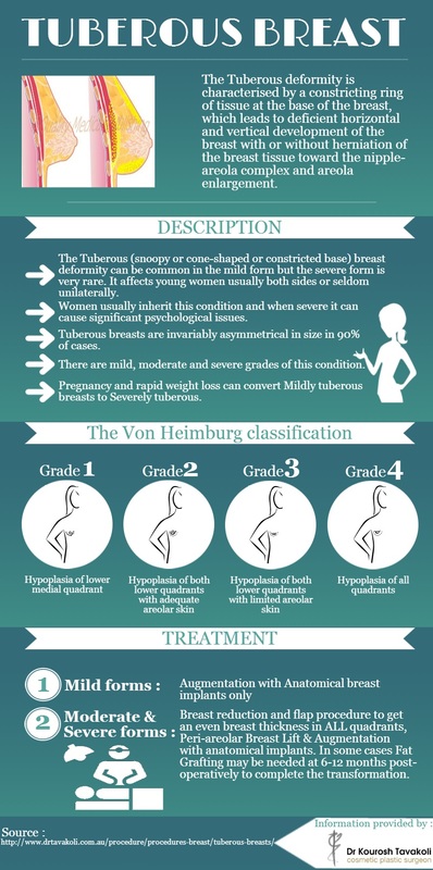 Tuberous Breast Infographic
