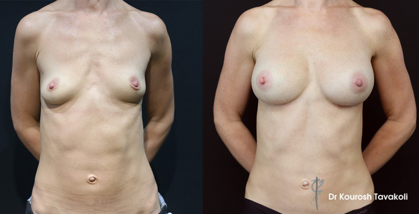 breast implants fatgrafting doublebay Fat Graft for Breast Contouring & Asymmetry - 3