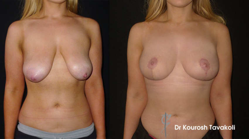 Breast lift/reduction with 120mls of fat into the upper pole of each breast.