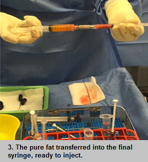 Fat graft for breast surgery procedure - step 3