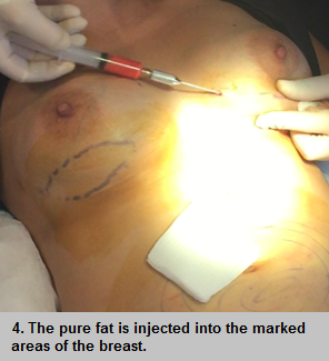 Fat graft for breast surgery procedure - step 4