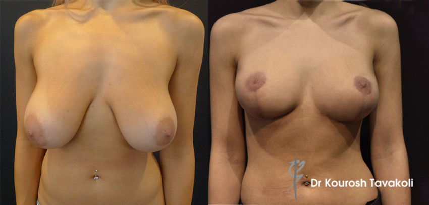 reduction fatgrafting sydney Fat Graft for Breast Contouring & Asymmetry - 6