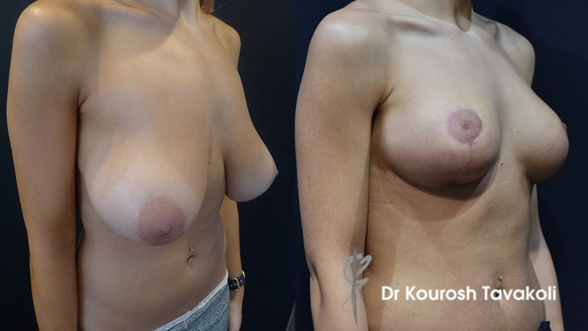 Breast Reduction with fat grafting to create upper pole fullness Total Fat Graft: 50mls (L) 30mls (R)