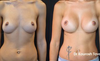 Breast Augmentation Before & After Gallery Thumbnail