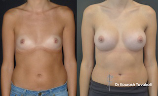 Breast Augmentation Before & After Gallery Thumbnail