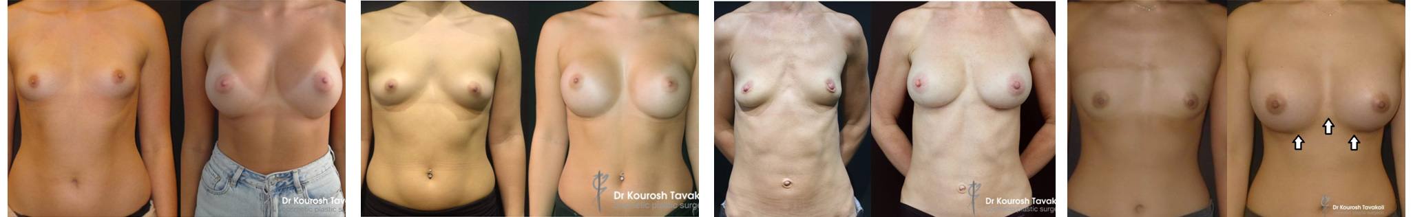 Fat graft with implants breast reshaping before and after gallery