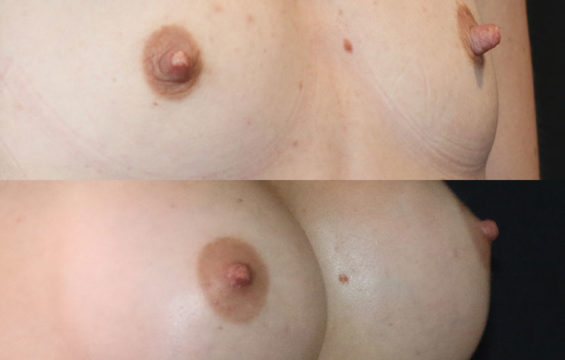 DB Breast Procedure Galleries - 6