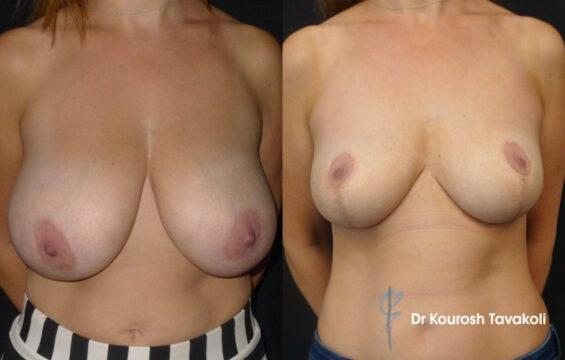 before after drtavakoli reduction Breast Procedure Galleries - 4