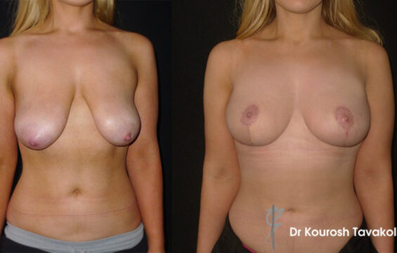 breast reduction lift fat raft Breast Procedure Galleries - 7