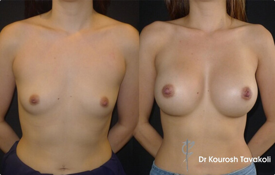 breast augmentation 1 Breast Augmentation Galleries - 1