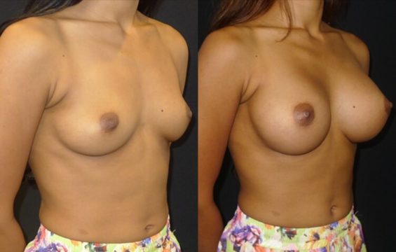 breast augmentation 2 Breast Augmentation Galleries - 2