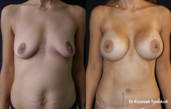 breast augmentation 3 Breast Augmentation Galleries - 3