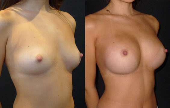 breast augmentation 4 Breast Augmentation Galleries - 4