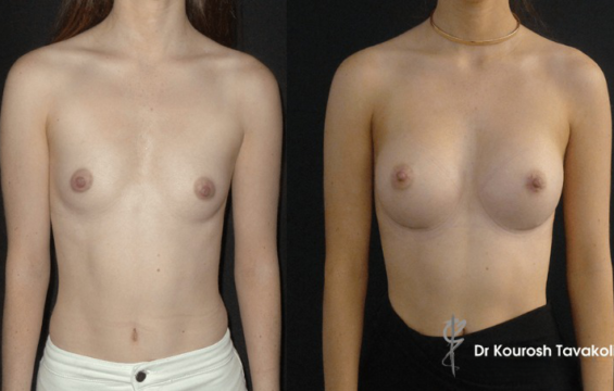 breast augmentation 6 Breast Augmentation Galleries - 6