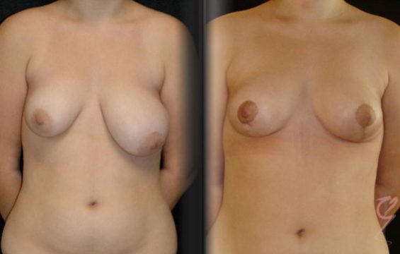 breast galleries1 Breast Procedure Galleries - 1