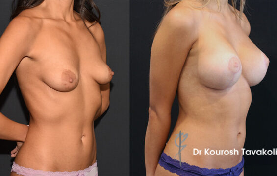 side lollypop mastopexy dr kourosh tavakoli Breast Procedure Galleries - 10
