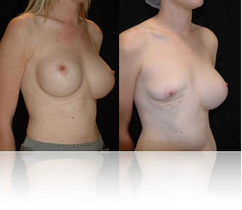 before breast reconstruction after removal Breast Implant Revision Surgery / Corrective Breast Implants - 5