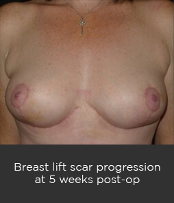 breastlift 1 Breast Lift (Mastopexy) Sydney - 8
