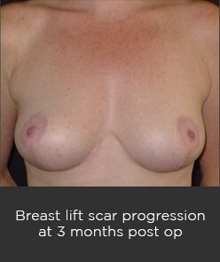 breastlift 2 Breast Lift (Mastopexy) Sydney - 9