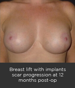breastlift 3 Breast Lift (Mastopexy) Sydney - 10