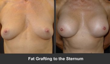 fat grafting to the sternum breast augmentation done at sydney NSW 2028 Australia’s Breast Augmentation Surgeon - 3